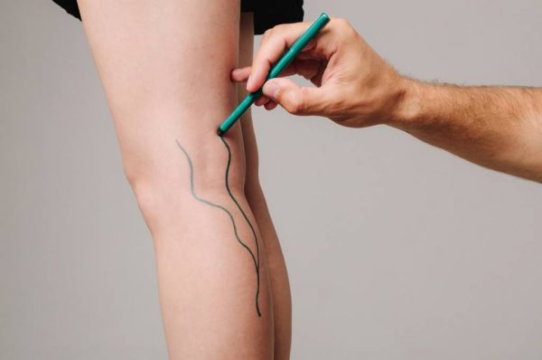 Trombosis venosa en pierna